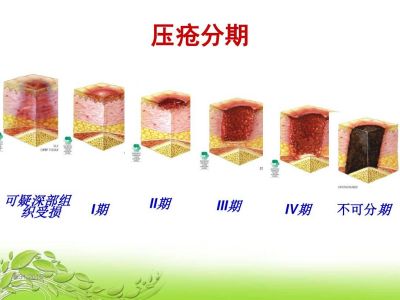 壓瘡的分期及臨床表現(xiàn)最新版